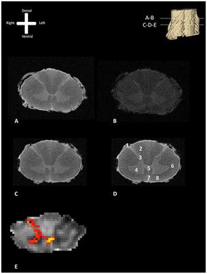 Post-mortem 11.7 Tesla Magnetic Resonance Imaging vs. Polarized Light Imaging Microscopy to Measure the Angle and Orientation of Dorsal Root Afferents in the Human Cervical Dorsal Root Entry Zone